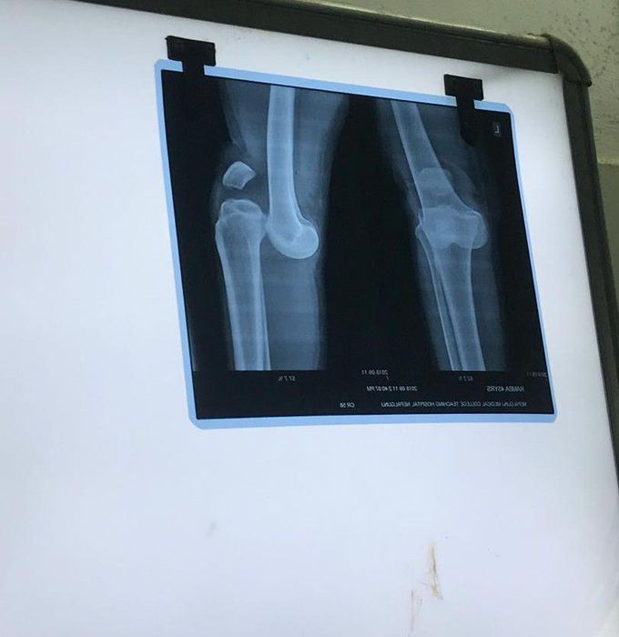 Fracture!!
