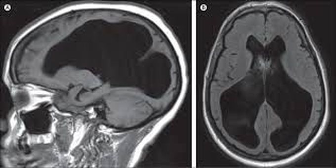 Hydrocephalus brain