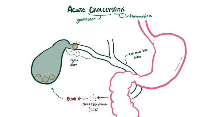 Acute cholecystitis