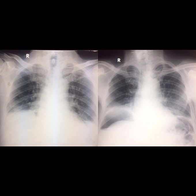 Optimal radiographic technique is important with suspected abdominal perforation