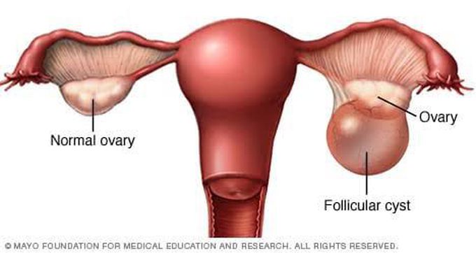 Ovarian cyst
