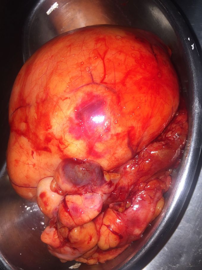 Quiste lipoma