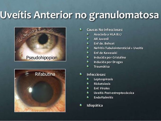 Uevitis anterior - MEDizzy