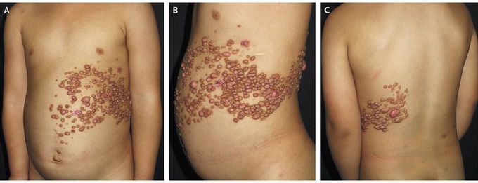 Segmental Neurofibromatosis