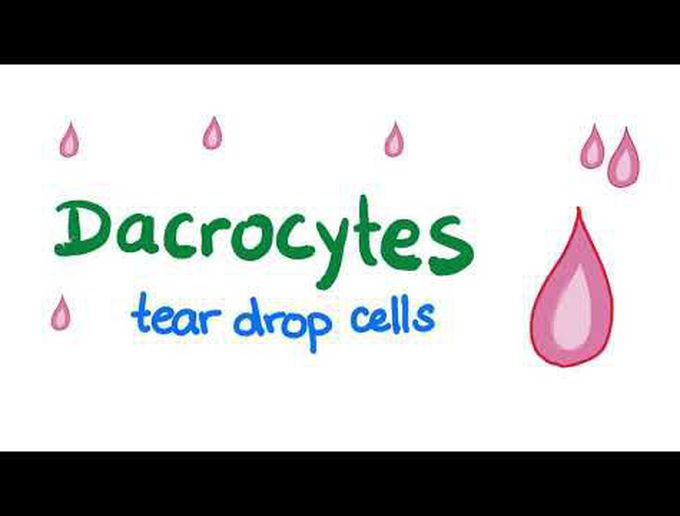 Dacrocytes (Teardrop Cells)