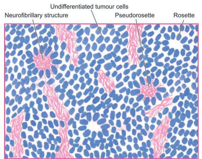 Neuroblastoma