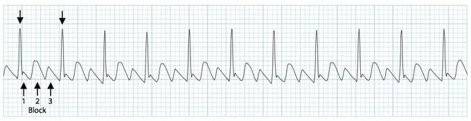 Atrial flutter