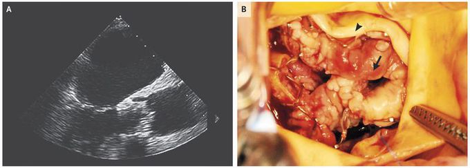 Candida Endocarditis after TAVR