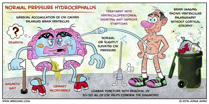 Normal pressure hydrocephalus - MEDizzy