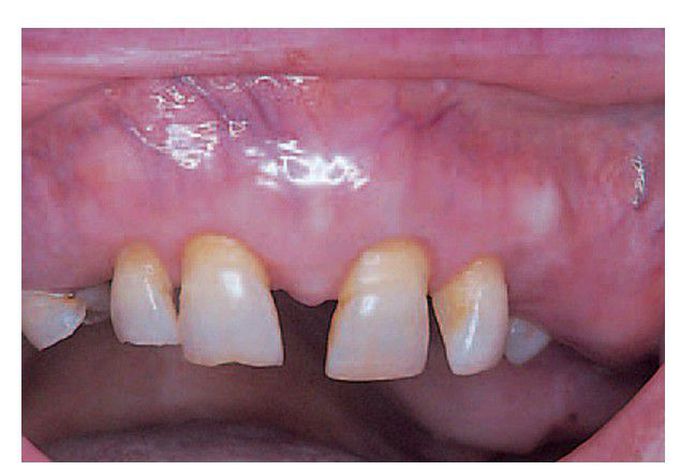 Paget’s disease of bone