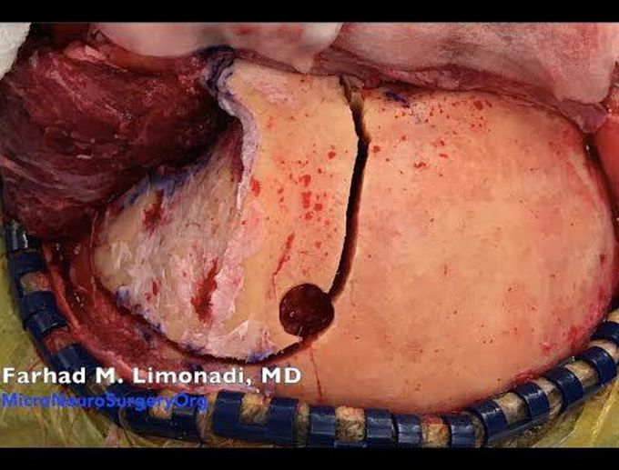 Surgery: Modified Orbitozygomatic (OZ) Craniotomy for meningioma