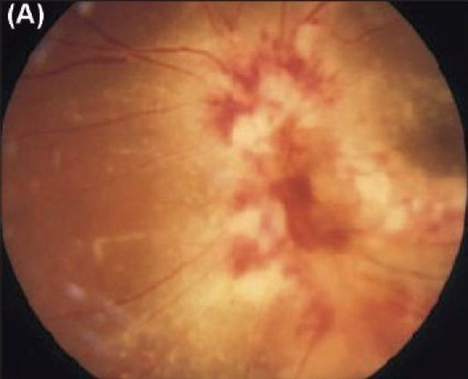 cmv retinitis