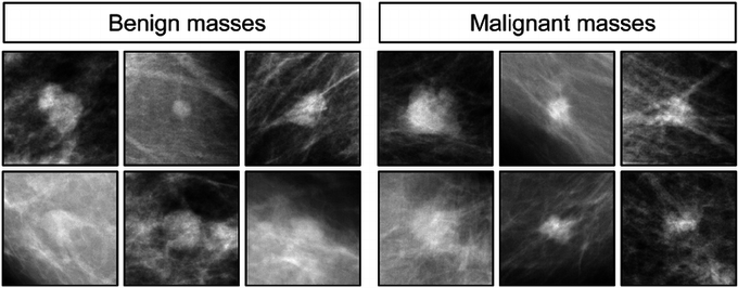 Features of Malignancy on Mammograph