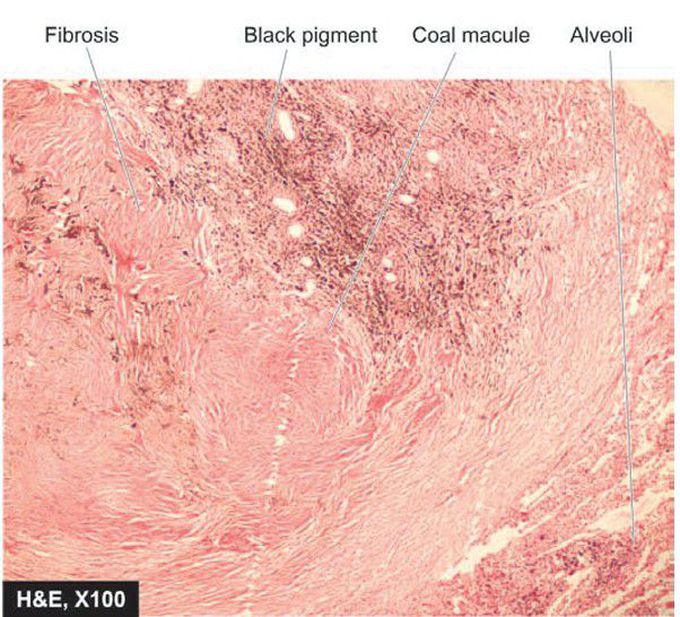 Coal-workers’ pneumoconiosis.