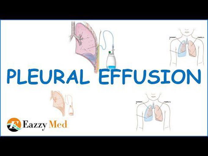 Pathology of Pleural Effusion