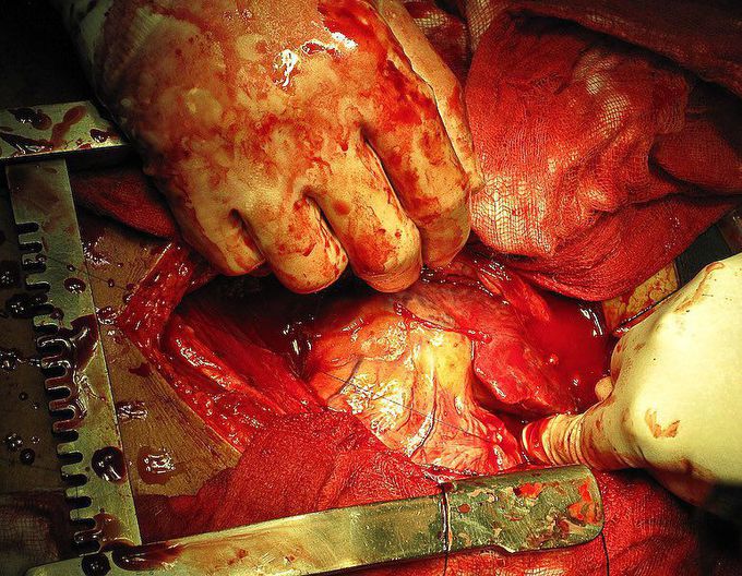 Median sternotomy for stab injury to left chest and ventricular laceration!