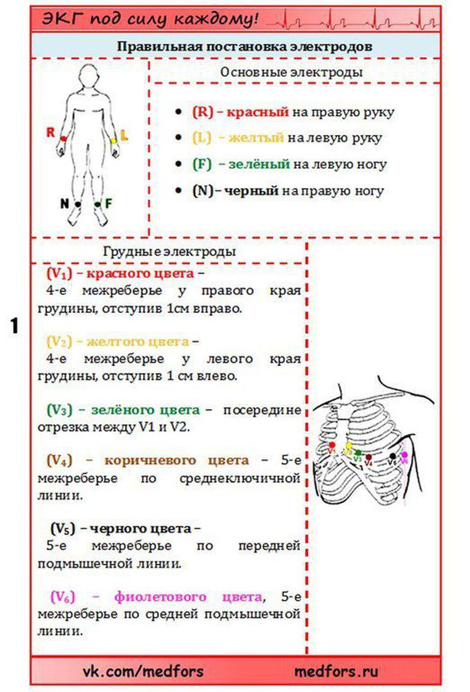 Экг как накладывать датчики