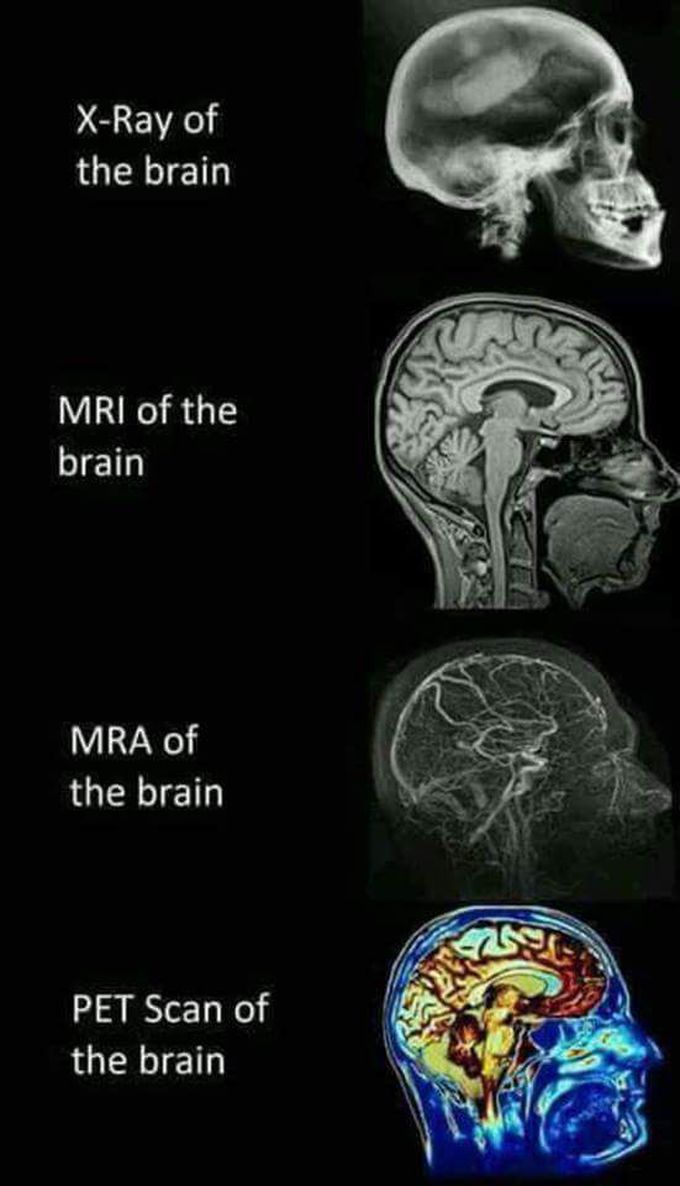 Different types of Brain Scans