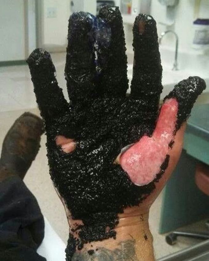 A case of 500 degree hot asphalt stuck on the patient's hand causing severe burns