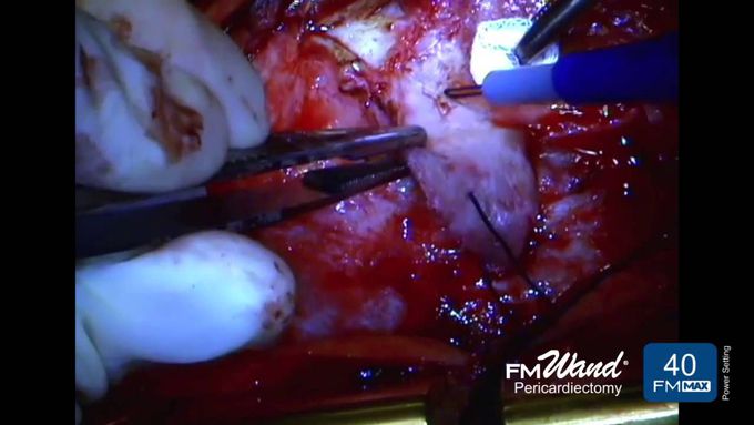 Pericardiectomy Procedure