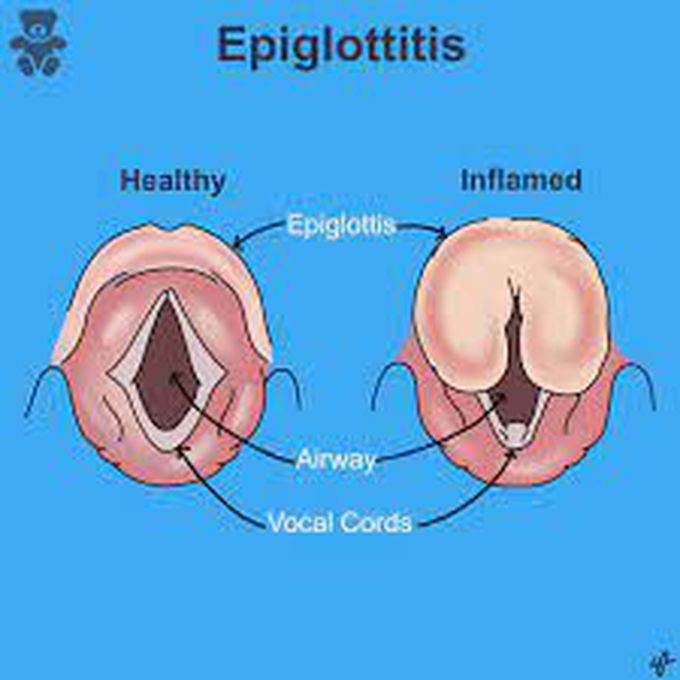 Epiglottitis