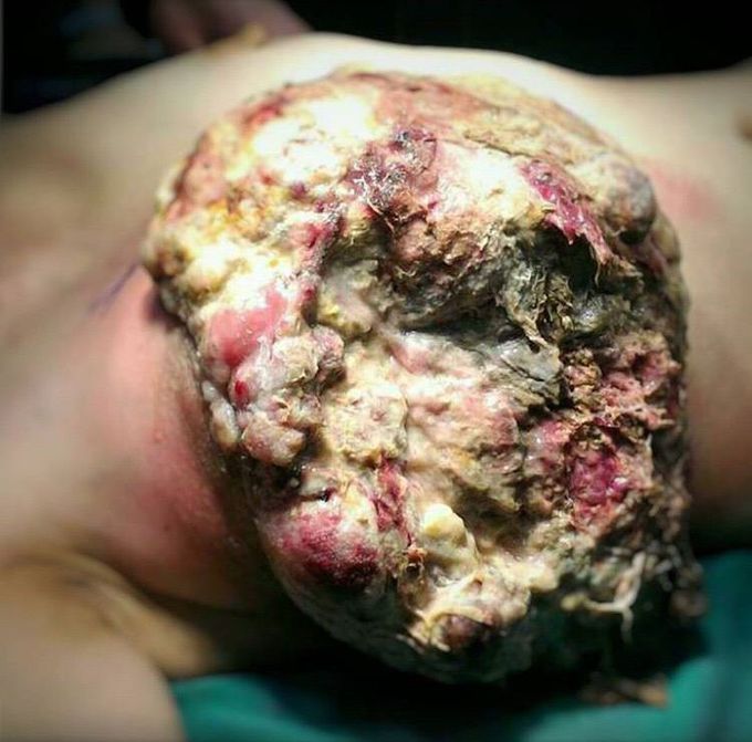 Breast tumor- 10kg! 😱