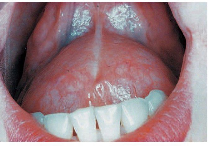 Sublingual dermoid cyst
