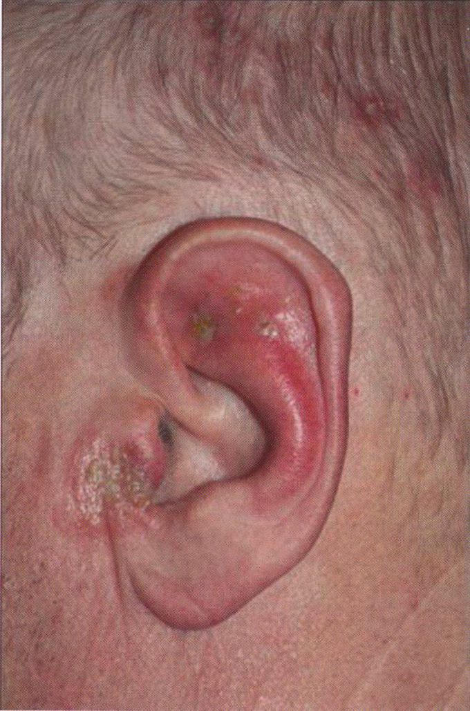 Ramsay Hunt syndrome