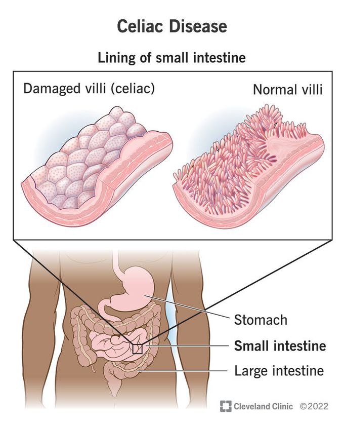 Complications of coeliac disease