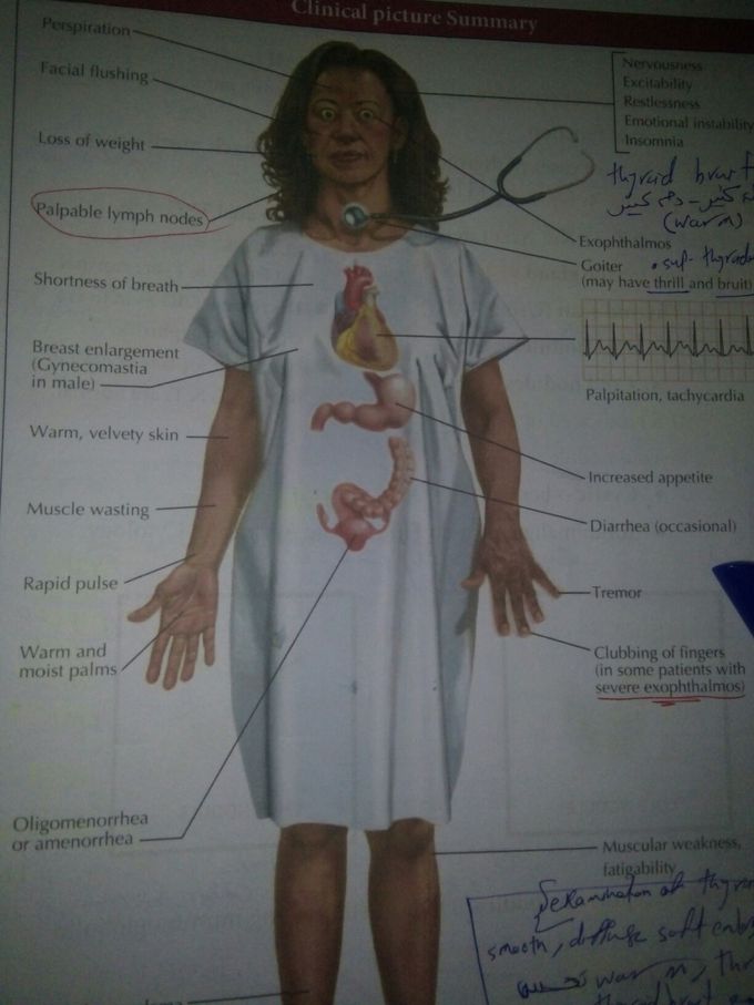 Take a breath and write one of clinical picture of thyrotoxicosis ✌