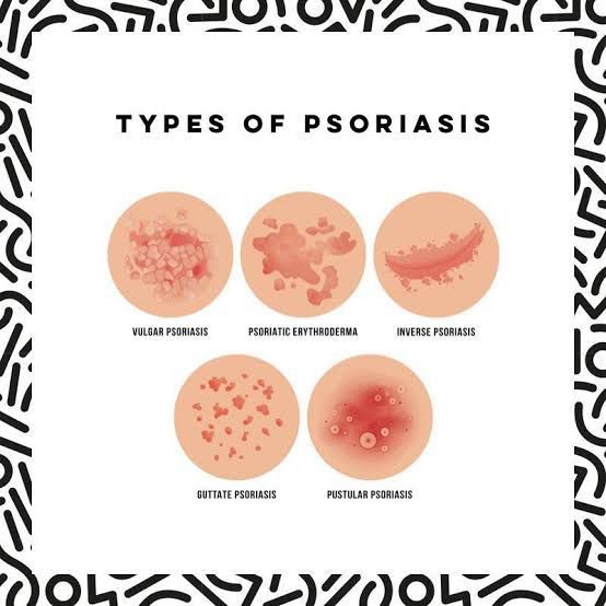Types of psoriasis - MEDizzy