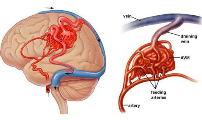 Treatment for brain lesion