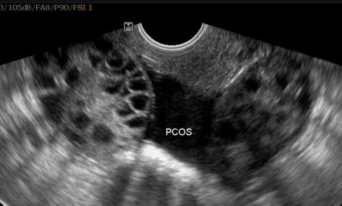 Polycystic ovary syndrome (PCOS)