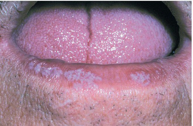 Lichen Planus.