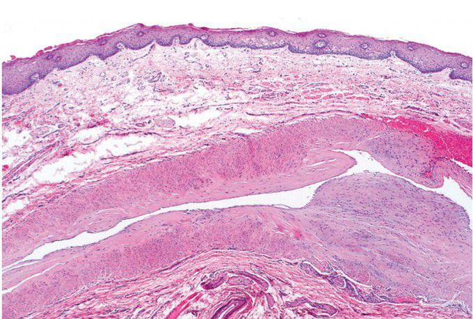 Caliber persistent artery histopathology