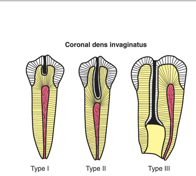 Dens invaginatus