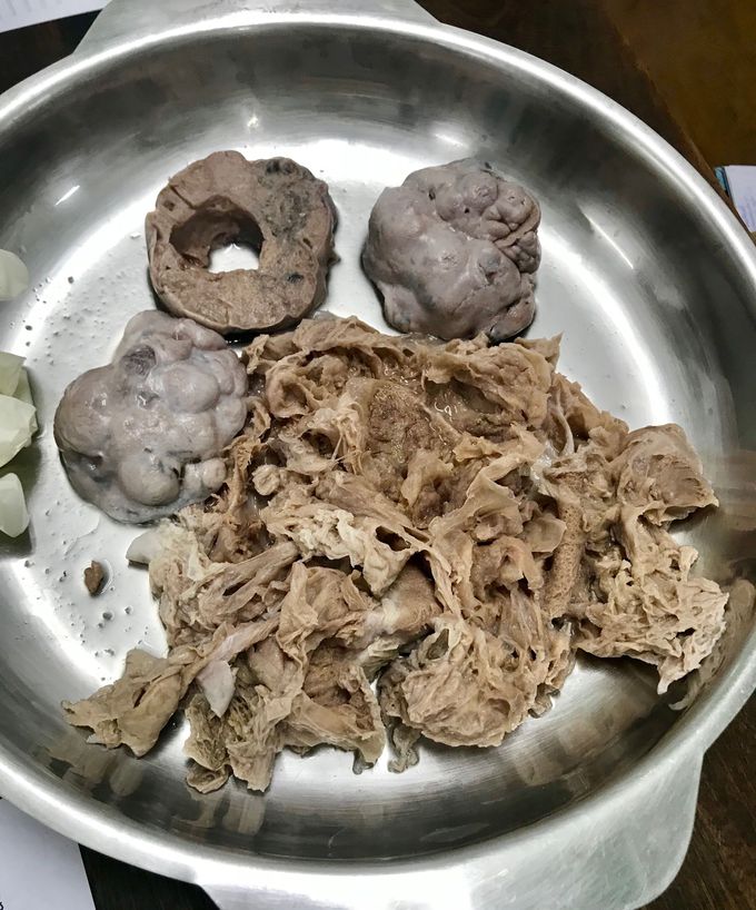 Ovarian Papillary Cystadenocarcinoma