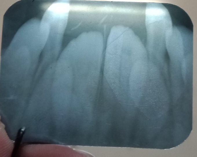 Impacted centrals