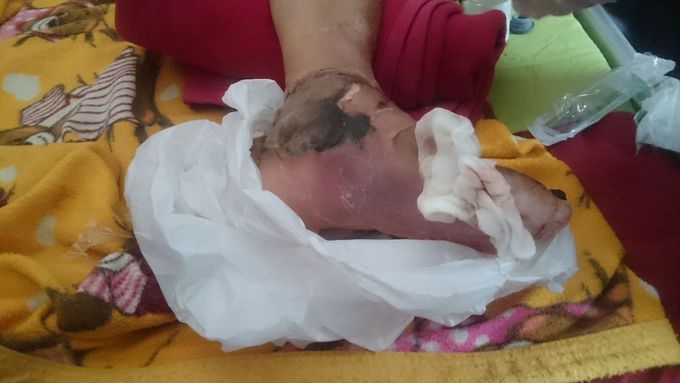 Debridement on diabetic foot