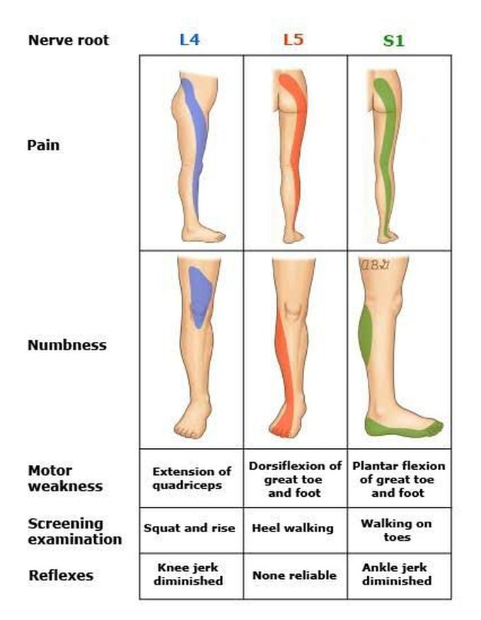 Presentation of lumbar Radiculopathy