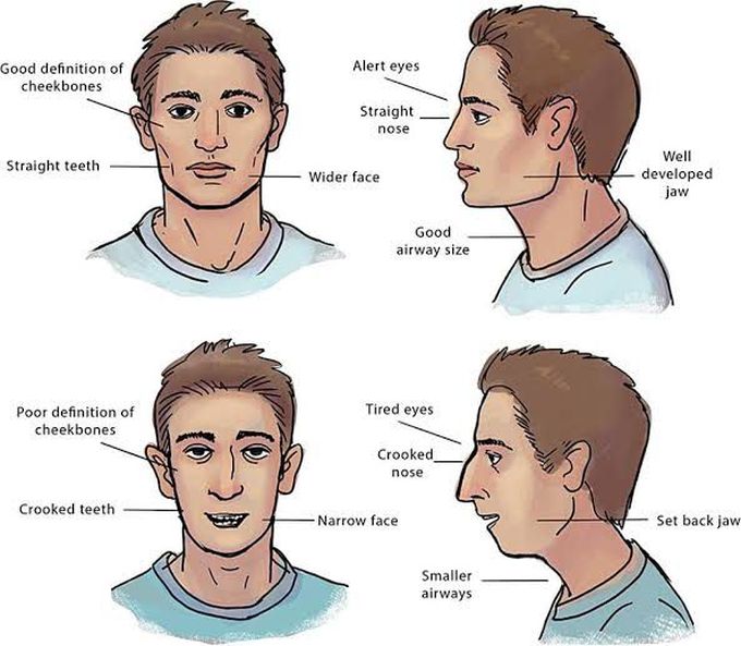 These are the symptoms of Orofacial syndrome