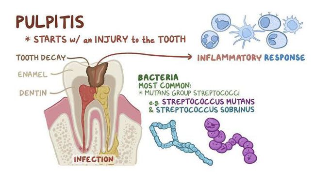 Pulpitis