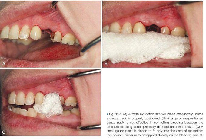 Post extraction socket care