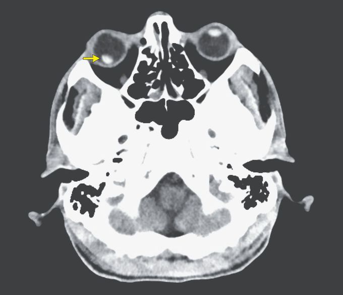 Intraocular Lens Dislocation