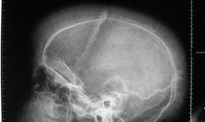 Crew cut skull appearance in Thalassemia