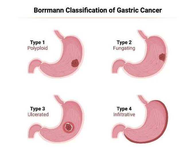 Borrmann Classification of Gastric Cancer