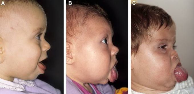 Beckwith–Wiedemann syndrome