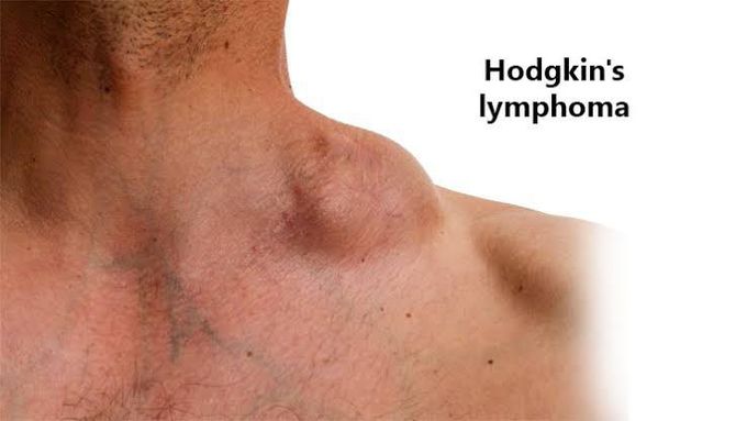 Symptoms of hodgkin's lymphoma?