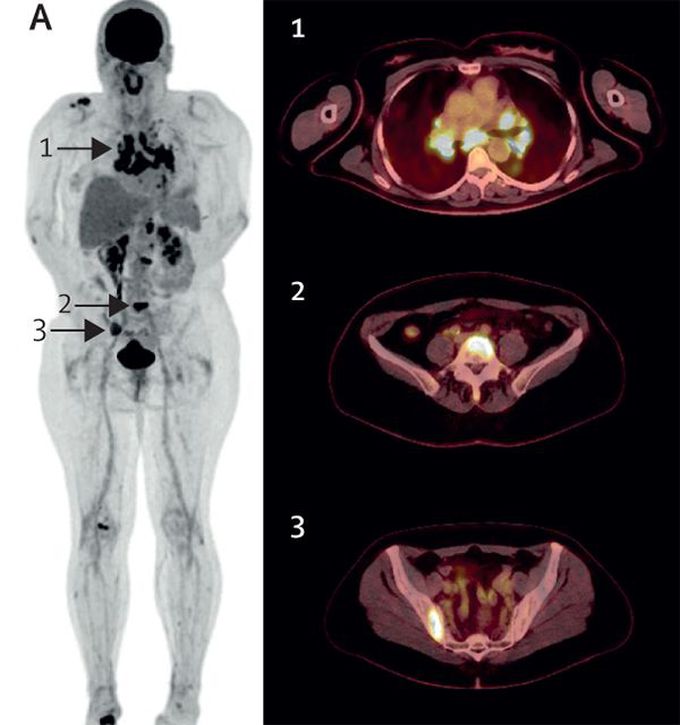 Sarcoid reaction mimicking bone metastases