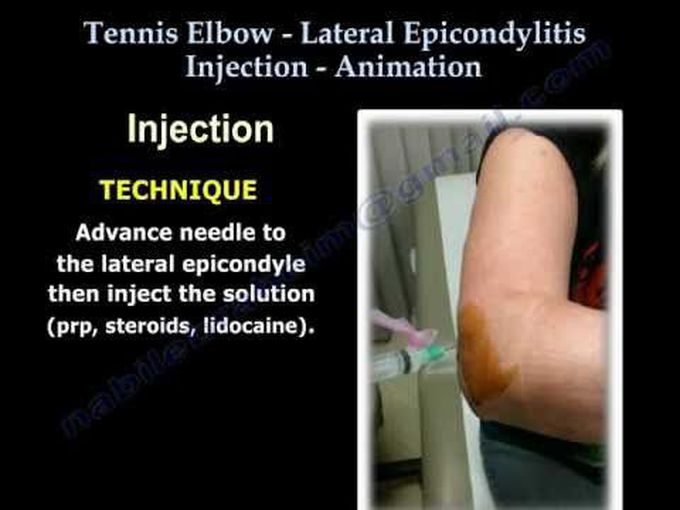 Lateral Epicondylitis Injection